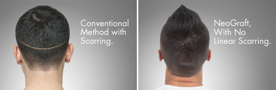 neograft before and after photo