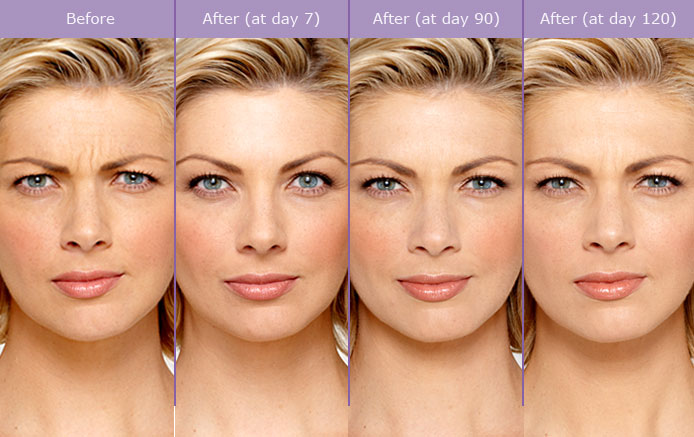Botox cosmetic injection treatment