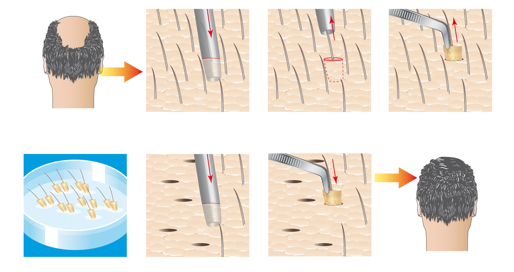 hair transplant infographic