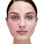 Before and after Pixel Perfect laser treatment