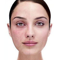 Before and after Pixel Perfect laser treatment