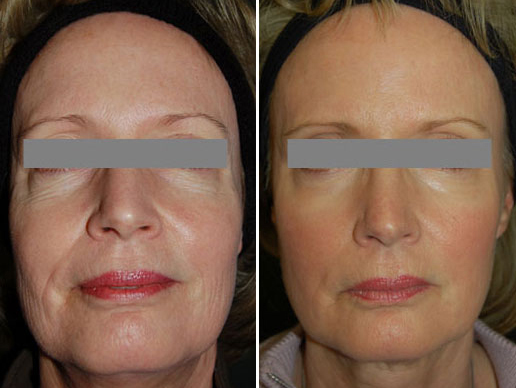Advanced facial skincare procedure