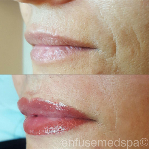 Full Lip Color Before & After Chicago