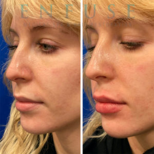 Restylane Results Chicago