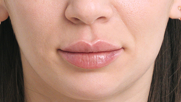 lip augmentaion after
